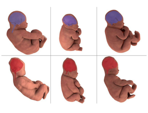 Accouchement : des médecins du CHU de Clermont-Ferrand étudient la déformation du crâne des bébés.